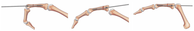 Intramedullary Screw Fixation of Proximal Phalangeal Fractures: Short- to Medium-Term Outcomes.