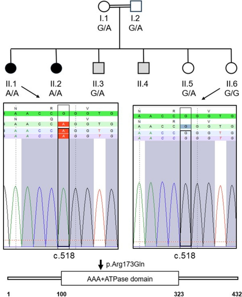 A homozygous TRIP13 pathogenic variant associated with familiar oocyte arrest and prematurely condensed sperm chromosomes.