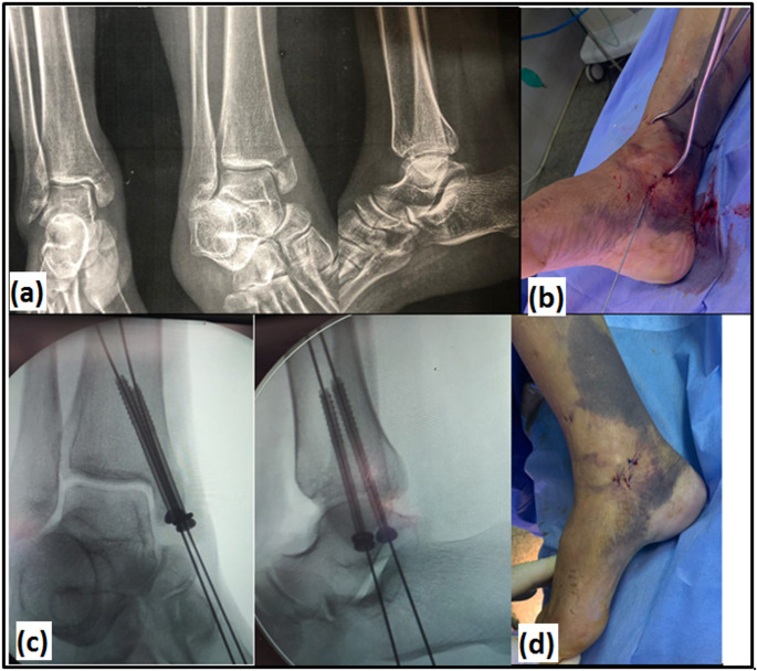 Percutaneous versus open cannulated screws fixation for displaced isolated medial malleolar fractures in adults: a randomized controlled clinical trial.