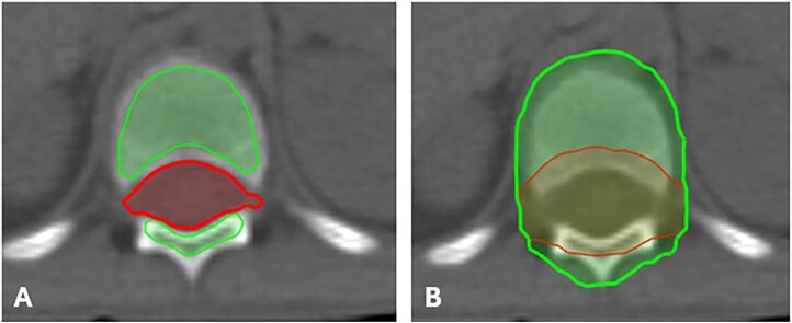 Relative risk of cardiac mortality and dosimetric comparison among three-dimensional radiotherapy, volume-modulated arc therapy and proton beam in vertebral-body reduced-dose craniospinal irradiation.