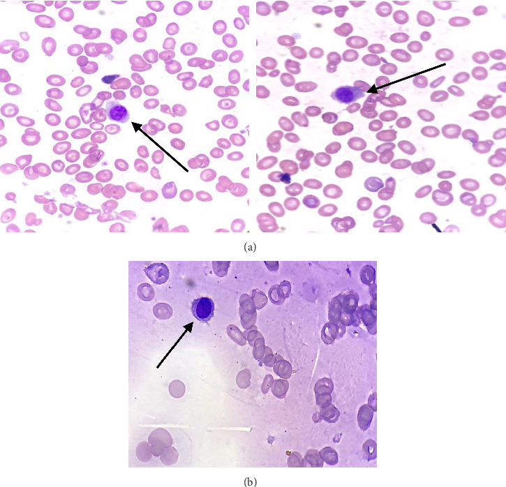 CD103-Negative Hairy Cell Leukemia: A Case Report From University Teaching Hospital, Zambia.