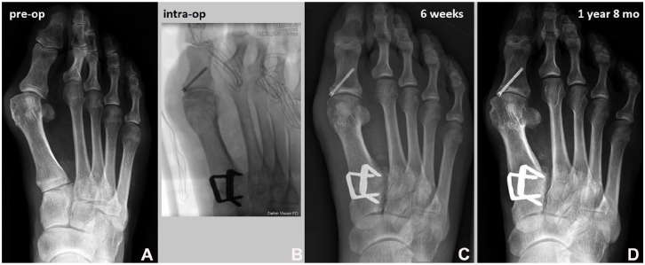 Clinical Outcomes of Lapidus Arthrodesis With Nitinol Staples for Hallux Valgus Correction.