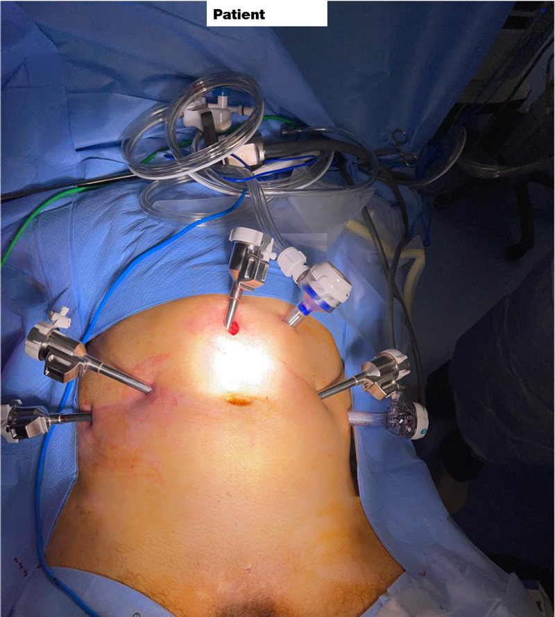 Salvage robotic-assisted radical cystectomy is safe in patients with history of pelvic irradiation.