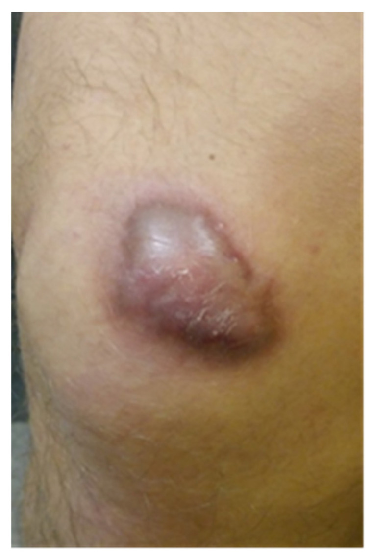 Assessment of the Effect of Kinesiology Taping on Scar Treatment in Children.