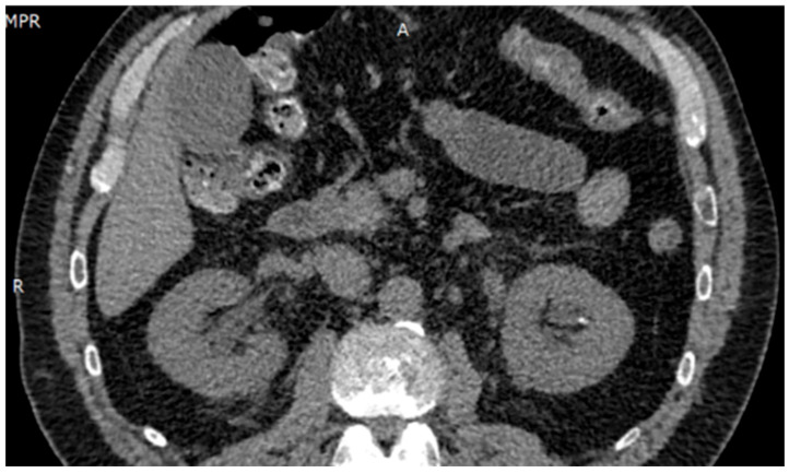 An Unusual Case of Anuric Acute Kidney Injury Secondary to the Use of Low-Dose Acetazolamide as Preventive Management for Acute Mountain Sickness.