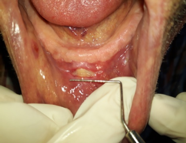 Investigation of traumatic ulcer locations and healing progression during denture adjustment periods in Syrian complete denture patients.