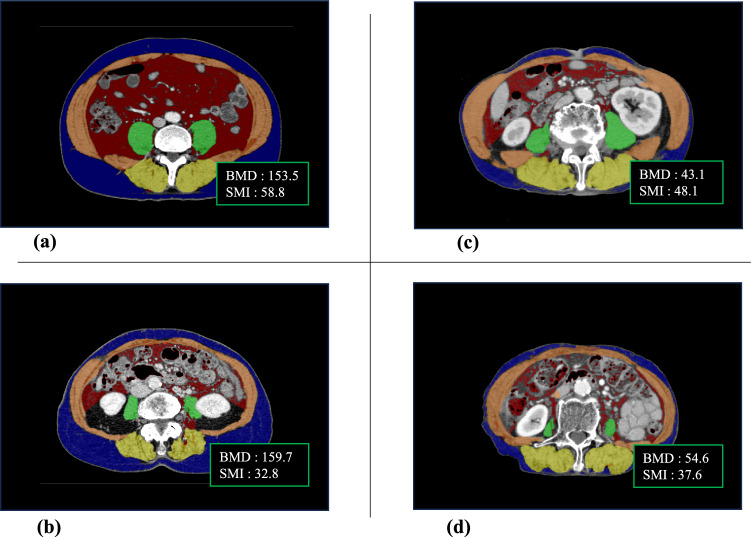 Function-preserving gastrectomy based on the sentinel node concept prevents osteosarcopenia in patients with gastric cancer.
