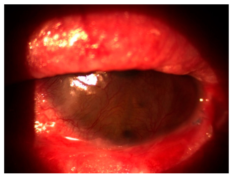 Rituximab Therapy in Refractory Ocular Cicatricial Pemphigoid: A Case Report.