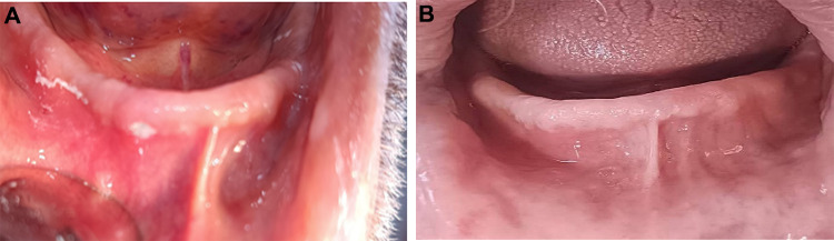 Investigation of traumatic ulcer locations and healing progression during denture adjustment periods in Syrian complete denture patients.
