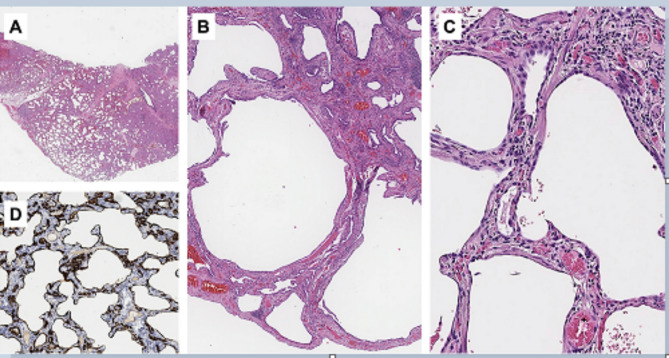 The lost chILD: a case report of delayed diagnosis of surfactant protein C deficiency in a 15-year-old African male.
