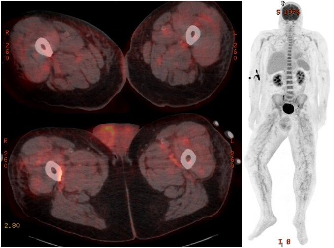 Polyarteritis nodosa with testicular involvement: a rare case report highlighting the role of nuclear imaging and angiography in diagnosis.
