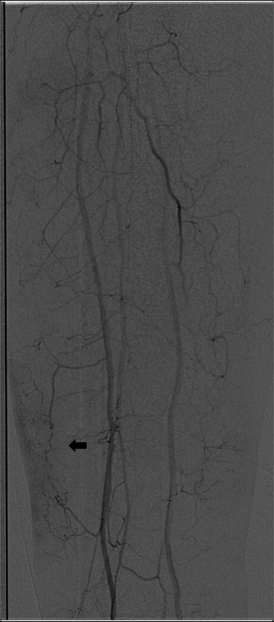 Severe complications following transarterial microembolization for a micro arterio-venous fistula in a patient with chronic venous ulcer: a case report.