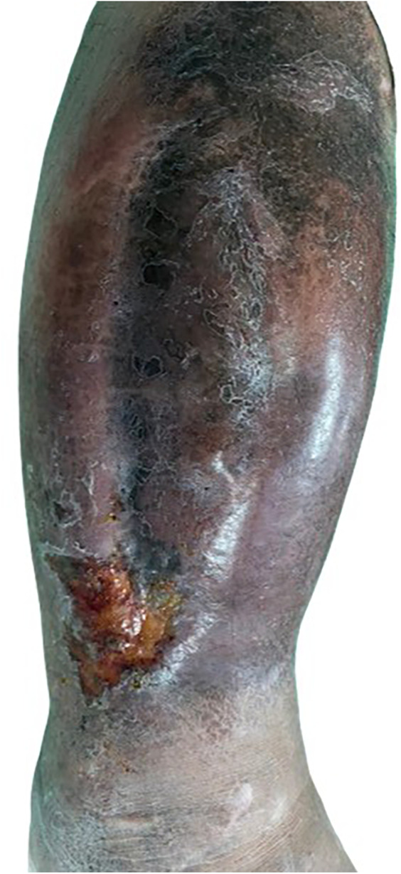 Severe complications following transarterial microembolization for a micro arterio-venous fistula in a patient with chronic venous ulcer: a case report.