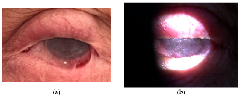 Rituximab Therapy in Refractory Ocular Cicatricial Pemphigoid: A Case Report.