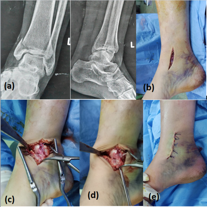 Percutaneous versus open cannulated screws fixation for displaced isolated medial malleolar fractures in adults: a randomized controlled clinical trial.