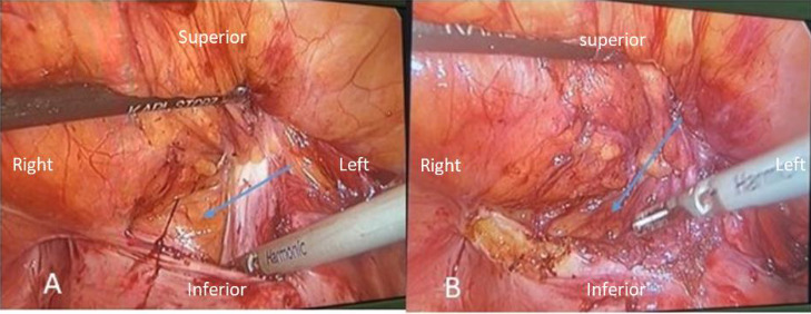 Laparoscopic Management of a Recurrent, Inguinal Hernia Containing Urinary Bladder: A Case Report and Literature Review.