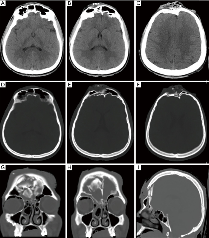 Primary reconstruction of depressed frontal bone fracture including cranialization of frontal sinus and repair of forehead skin: a case report and literature review.