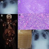 Chylothorax in Uncommon Contexts: Pulmonary Tuberculosis and Mantle Cell Lymphoma.