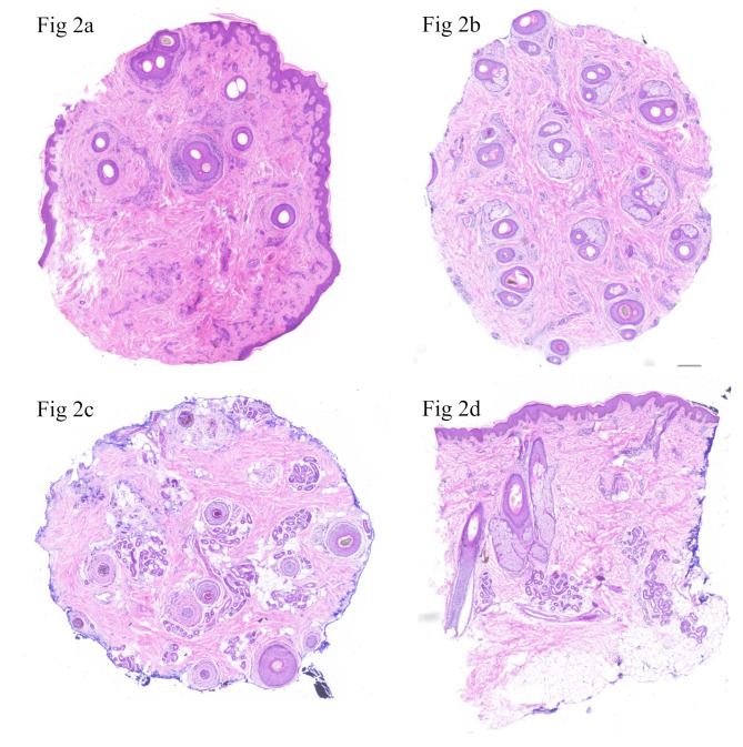 Hypotrichosis 14: novel variants of the LSS gene in five Chinese families and insights from literature review.