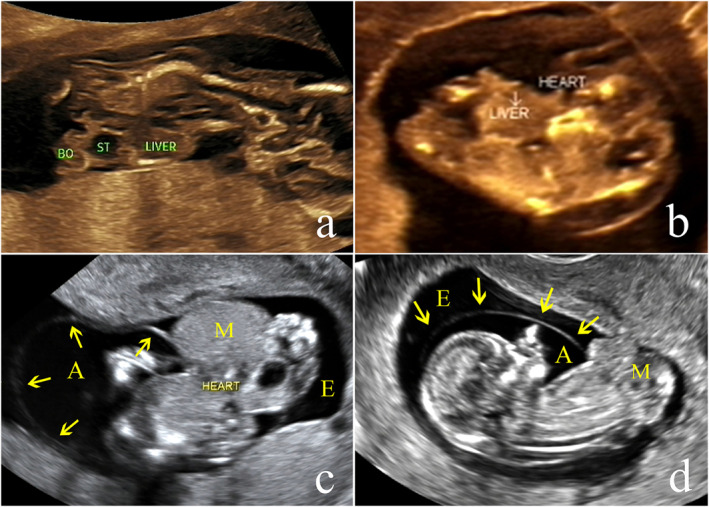 Characteristic Analysis of Ultrasound Diagnosis of Limb Body Wall Complex in Early Pregnancy.