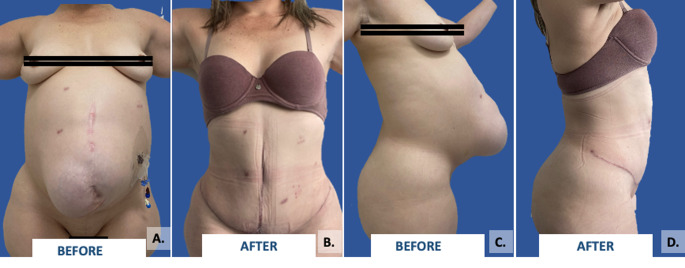 Clinical and perioperative outcomes of abdominal wall reconstruction and panniculectomy in a single surgical procedure: experience from a high-complexity center in bogotá, Colombia.