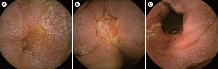 Clinical characteristics and long-term disease course in patients with Crohn's disease as diagnosed by video capsule endoscopy: a multicenter retrospective matched case-control study.