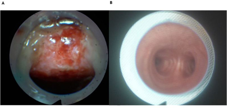 Plea for routine endoscopic tracheostomy tube adjustment.