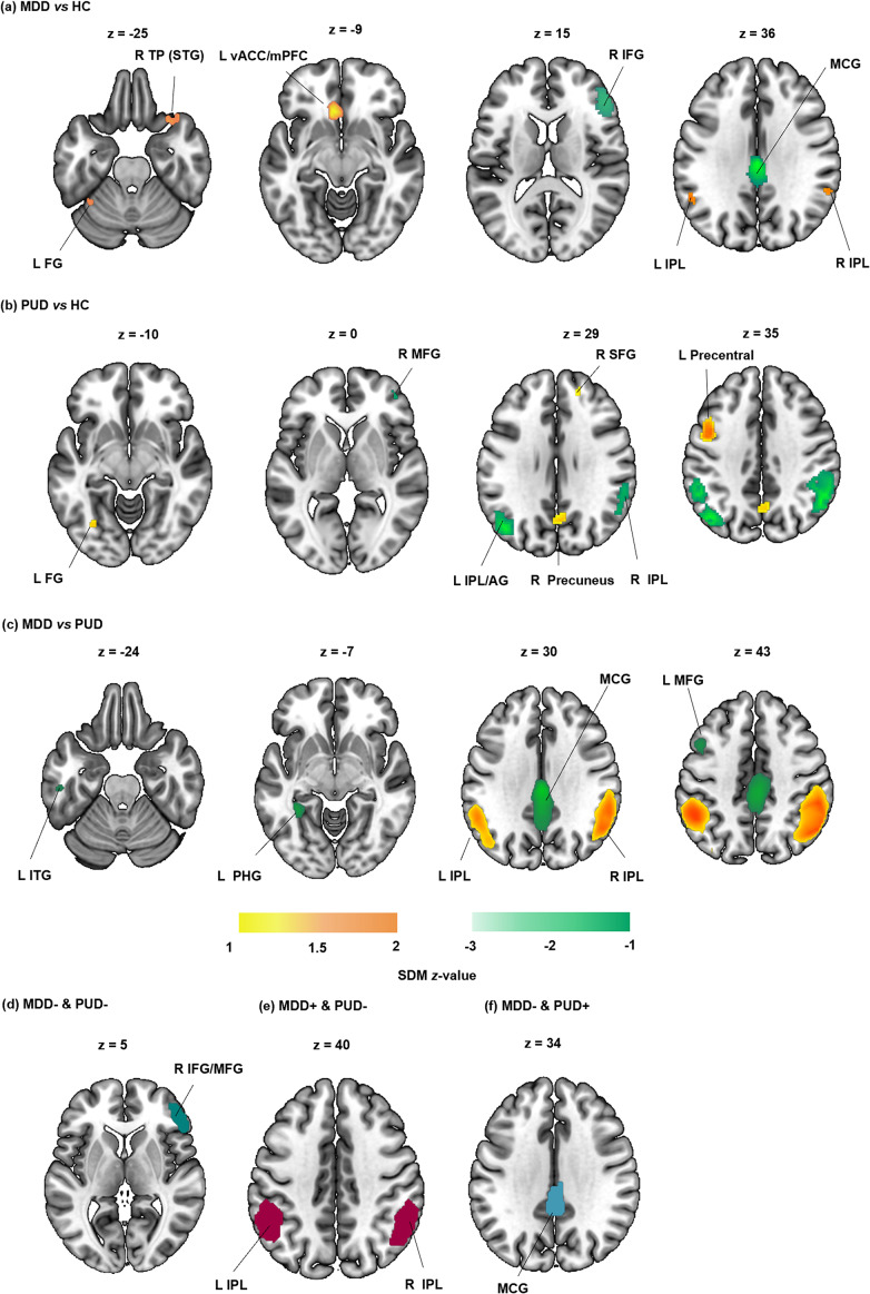 Common and distinct patterns of brain activity alterations during inhibitory control in depression and psychostimulant users: a comparative meta-analysis of task-based fMRI studies.