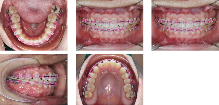 Impact of Camouflage Treatment with Class III Elastics on Temporomandibular Joint and Dentoskeletal Relationships: A Pilot CBCT and MRI-Based Clinical Trial.