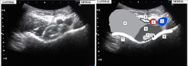 Comparison of the perioperative efficacy of pericapsular nerve group (PENG) block and the suprainguinal fascia iliaca compartment block (S-FICB) in patients undergoing hip fracture surgery: Spinal positioning, medication usage, and patient satisfaction.