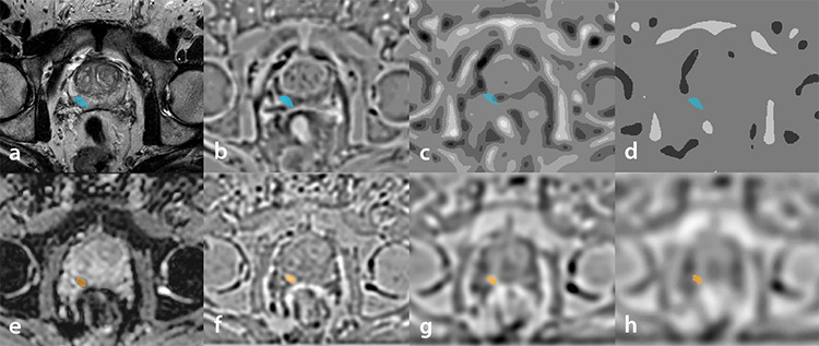 Machine learning models for discriminating clinically significant from clinically insignificant prostate cancer using bi-parametric magnetic resonance imaging