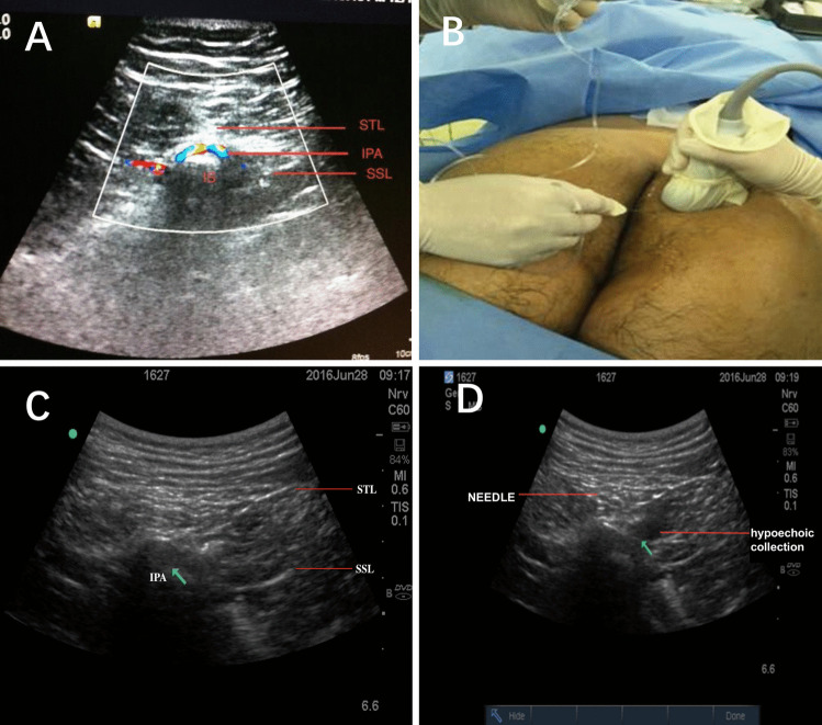 Ultrasound-guided pudendal nerve block for postoperative pain management in procedures for prolapse and hemorrhoids: a randomized, double-blinded trial.