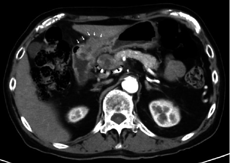 A Case of Ventricular Arrhythmia in a Patient With HER2-Positive Gastric Cancer Receiving Trastuzumab.