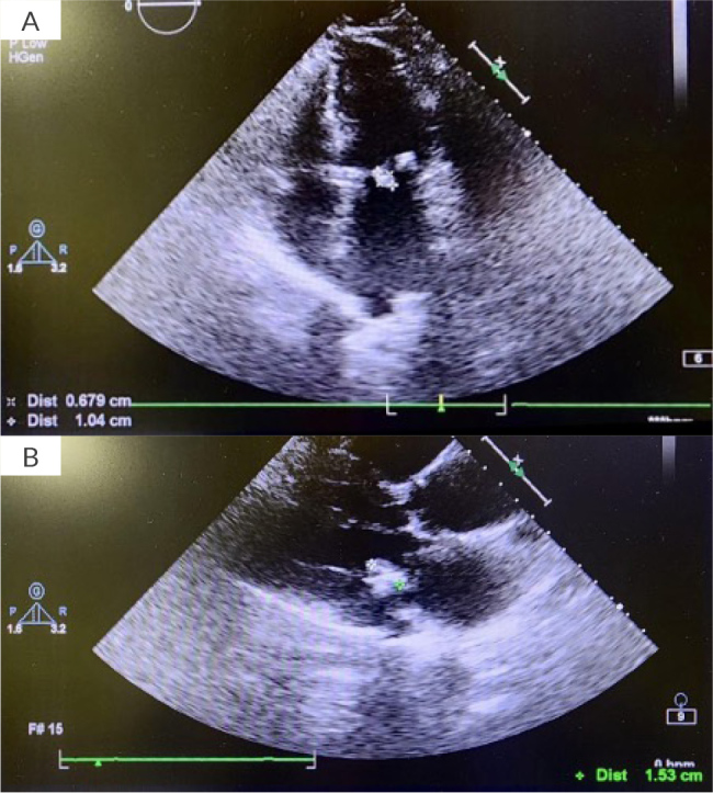 Isolated Mitral Valve Hydatid CYST Mimicking Myxoma: A Rare Case of Mitral Valve Echinococcosis.