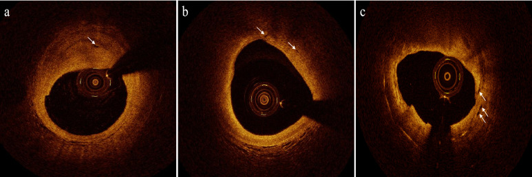 Neovascularization in Atherosclerotic Plaques: Clinical Implications, Detection, and Prevention Strategies.