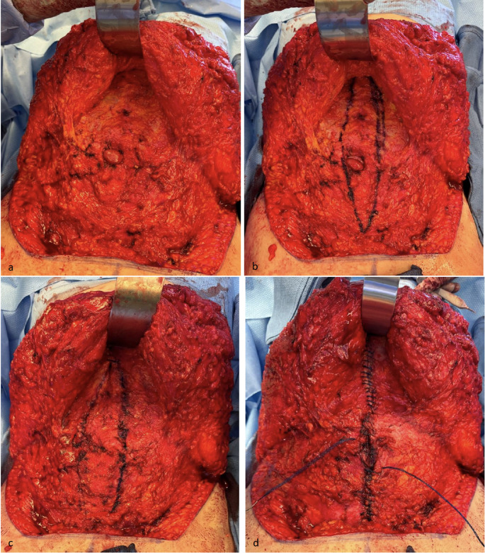 Mesh suture repair of rectus diastasis with and without a concurrent ventral hernia.