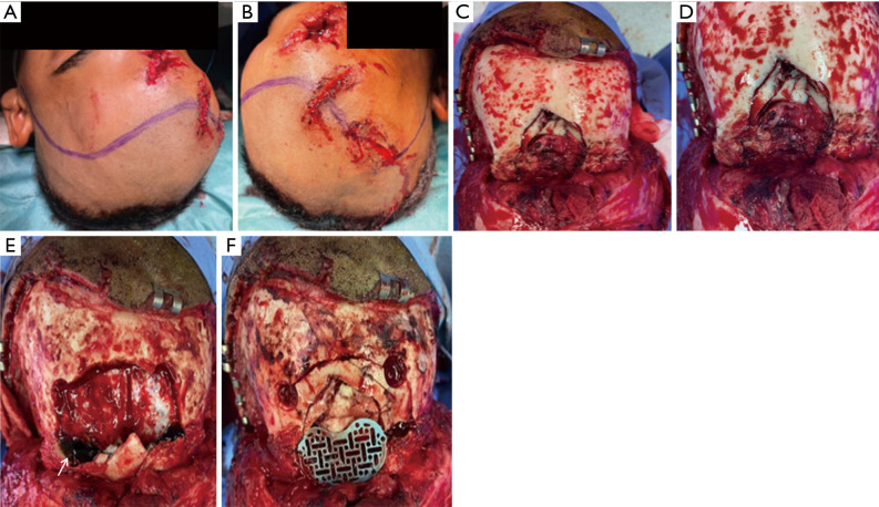 Primary reconstruction of depressed frontal bone fracture including cranialization of frontal sinus and repair of forehead skin: a case report and literature review.