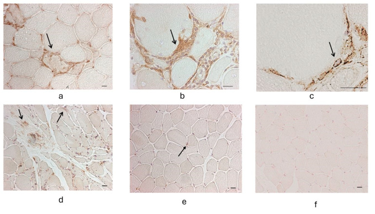 G-Protein-Coupled Estrogen Receptor (GPER) in Inflammatory Myopathies.