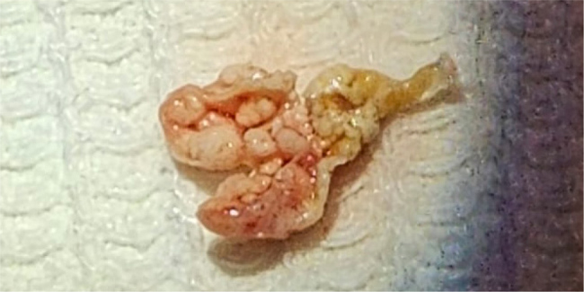 Isolated Mitral Valve Hydatid CYST Mimicking Myxoma: A Rare Case of Mitral Valve Echinococcosis.