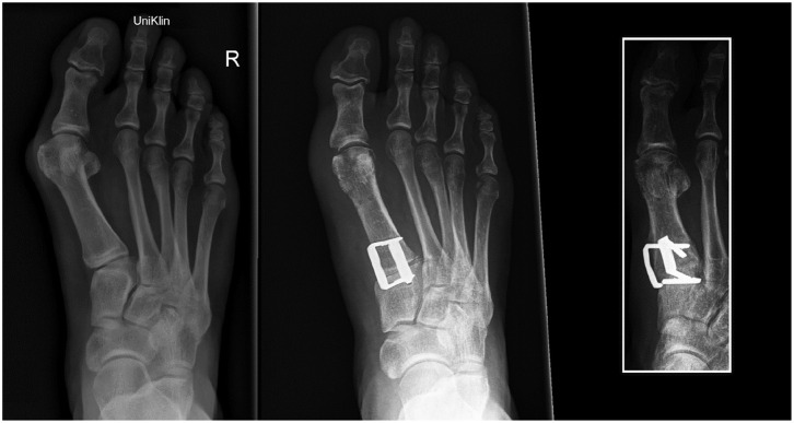 Clinical Outcomes of Lapidus Arthrodesis With Nitinol Staples for Hallux Valgus Correction.