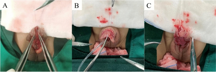 Application of glanular decompression and expansion surgery in proximal hypospadias with hypoplastic glans penis.