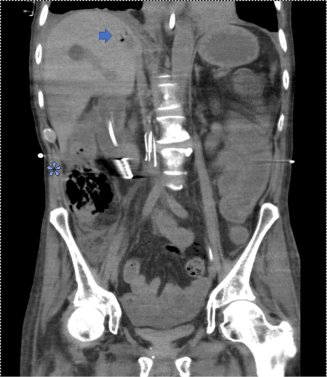 Multifocal bowel perforation from angioinvasive aspergillosis after bilateral lung transplantation: a case report and review of the literature.