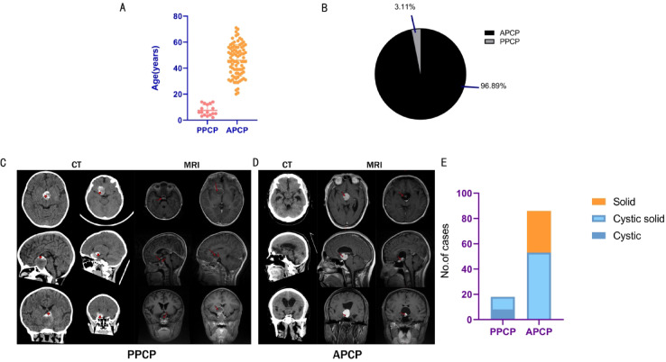 Comparative analysis of clinical features, methylation and immune microenvironment in pediatric and adult papillary craniopharyngiomas: results from a multicenter study.