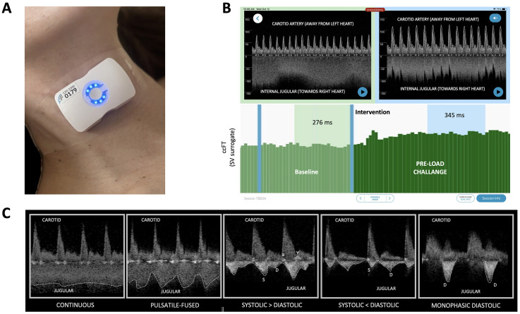 Jugular Venous Doppler Ultrasound as a Non-Invasive Window to Right Heart Hemodynamics: A Narrative Review and Future Perspective.