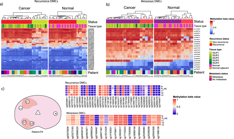 DNA methylation in normal-appearing tissue associated with prostate cancer recurrence and metastasis.
