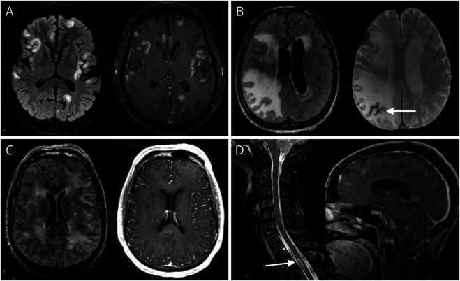 Biopsy-Confirmed Small Vessel Primary CNS Vasculitis: Clinical Features and Impact of Early Intensive Treatment on Remission.