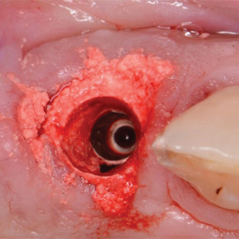 A Retrospective Study Using a Novel Body-Shift Implant Design with a Novel Alloplastic Particulate Grafting Material in Immediate Extraction Sockets.