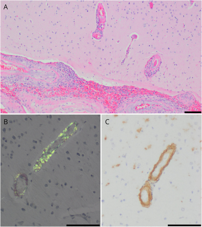 Biopsy-Confirmed Small Vessel Primary CNS Vasculitis: Clinical Features and Impact of Early Intensive Treatment on Remission.