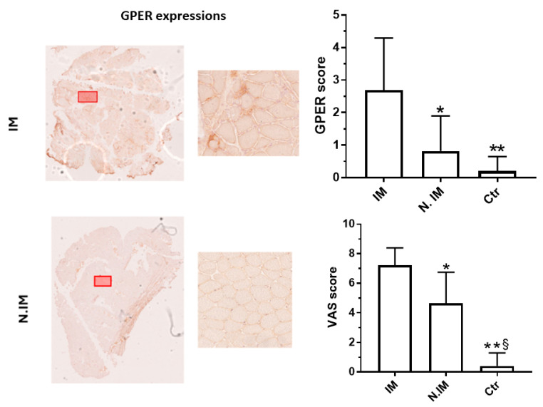 G-Protein-Coupled Estrogen Receptor (GPER) in Inflammatory Myopathies.