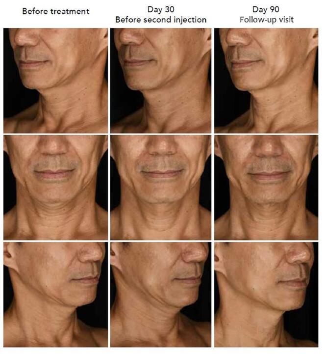 Patient Satisfaction Using Hybrid Cooperative Complexes of Hyaluronic Acid for Neck Laxity: A Survey of Asian Populations.